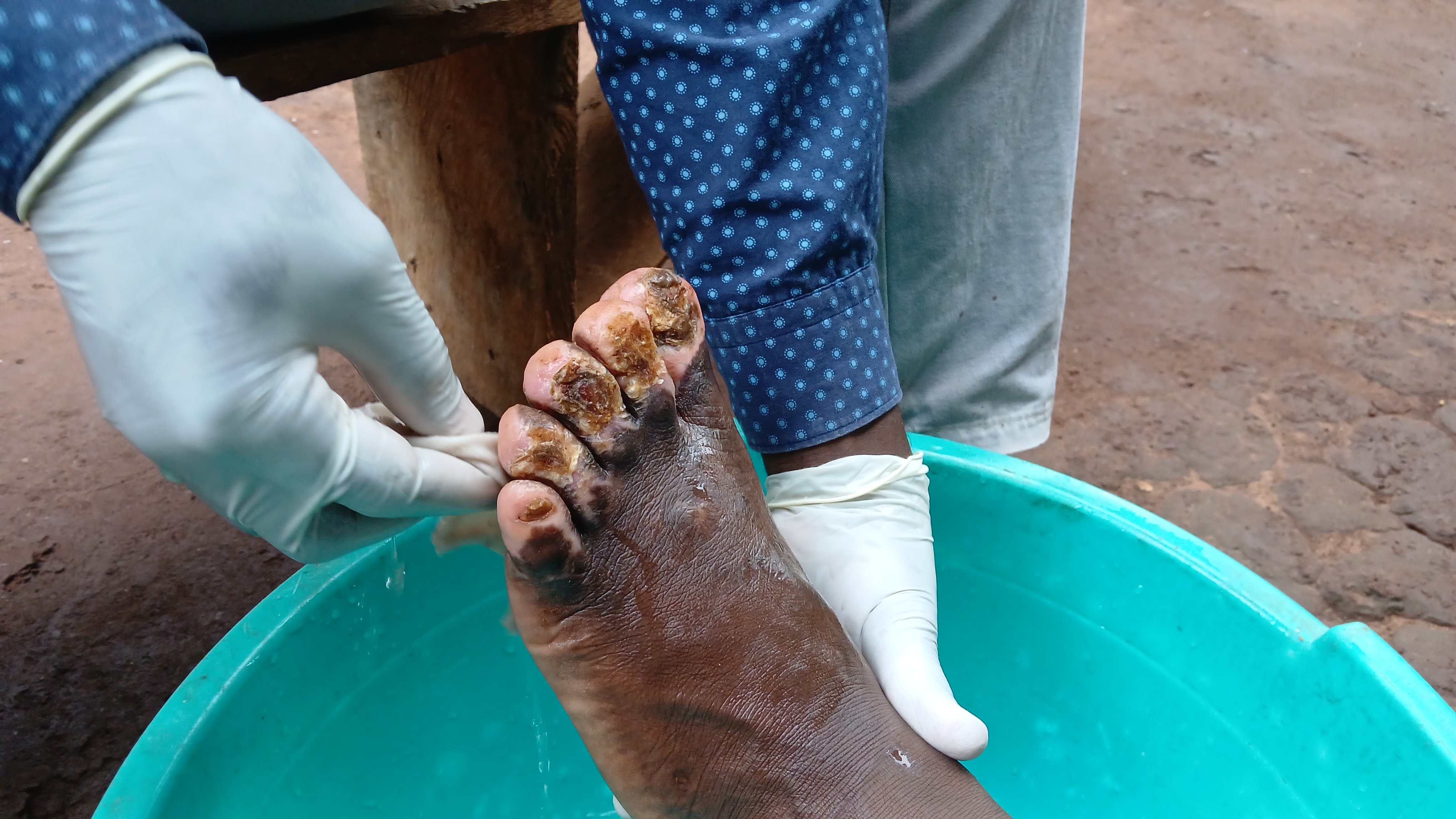 Treating a woman burnt with hot boiling milk
